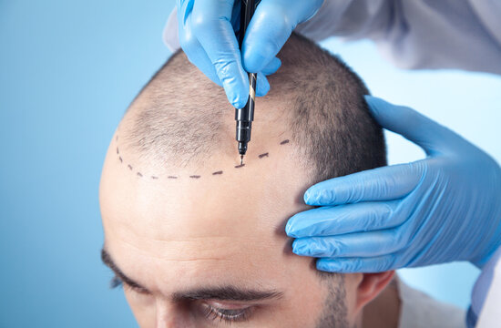 Happy hair transplant patient