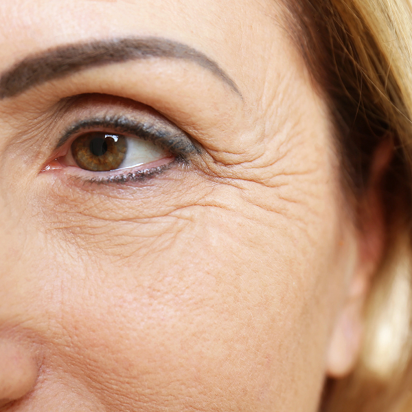 Aging Skin