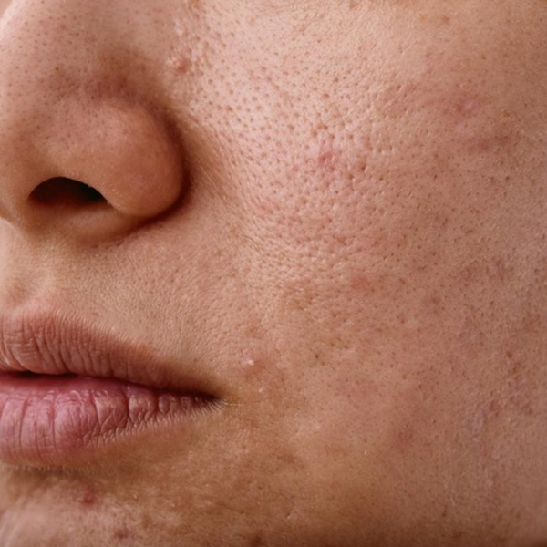 Dull Skin