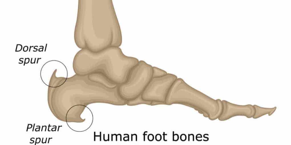 heel spur image