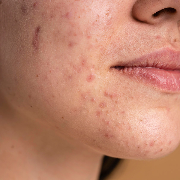 Acne Prone Skin